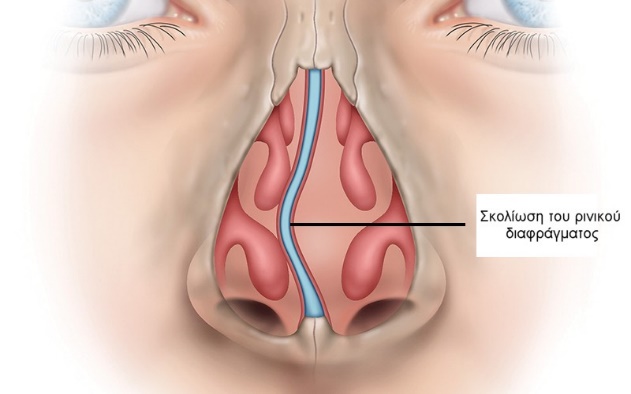 Nasal Septum deviation
