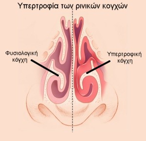 Hypertrophy of lower nasal conchae