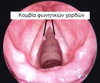 Laryngeal Diseases